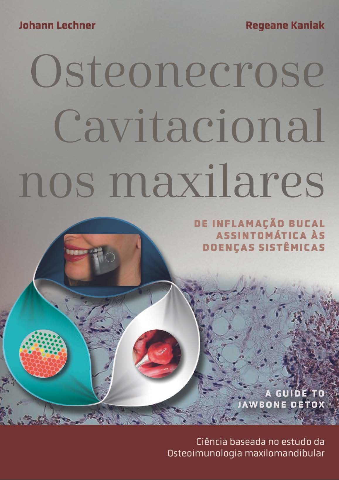 Livro Osteonecrose Cavitacional nos Maxilares