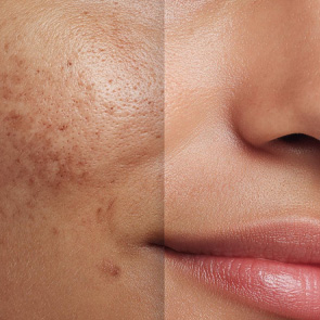 Protocolo Coreano Melasma Zero