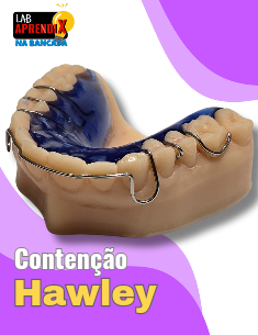 Contenção de Hawley - Na Bancada